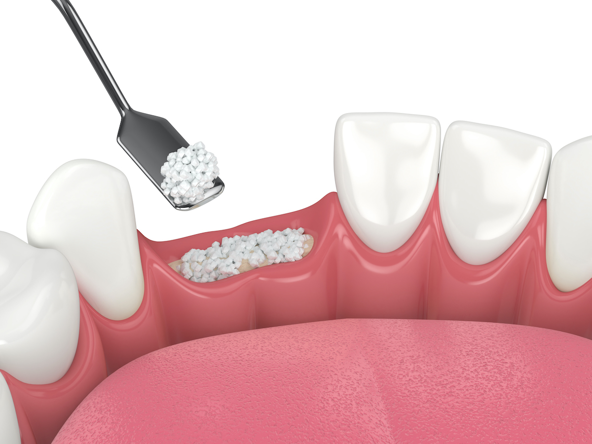 Illustration of a metal tool filling a gap from a missing tooth with a special material during a bone graft procedure