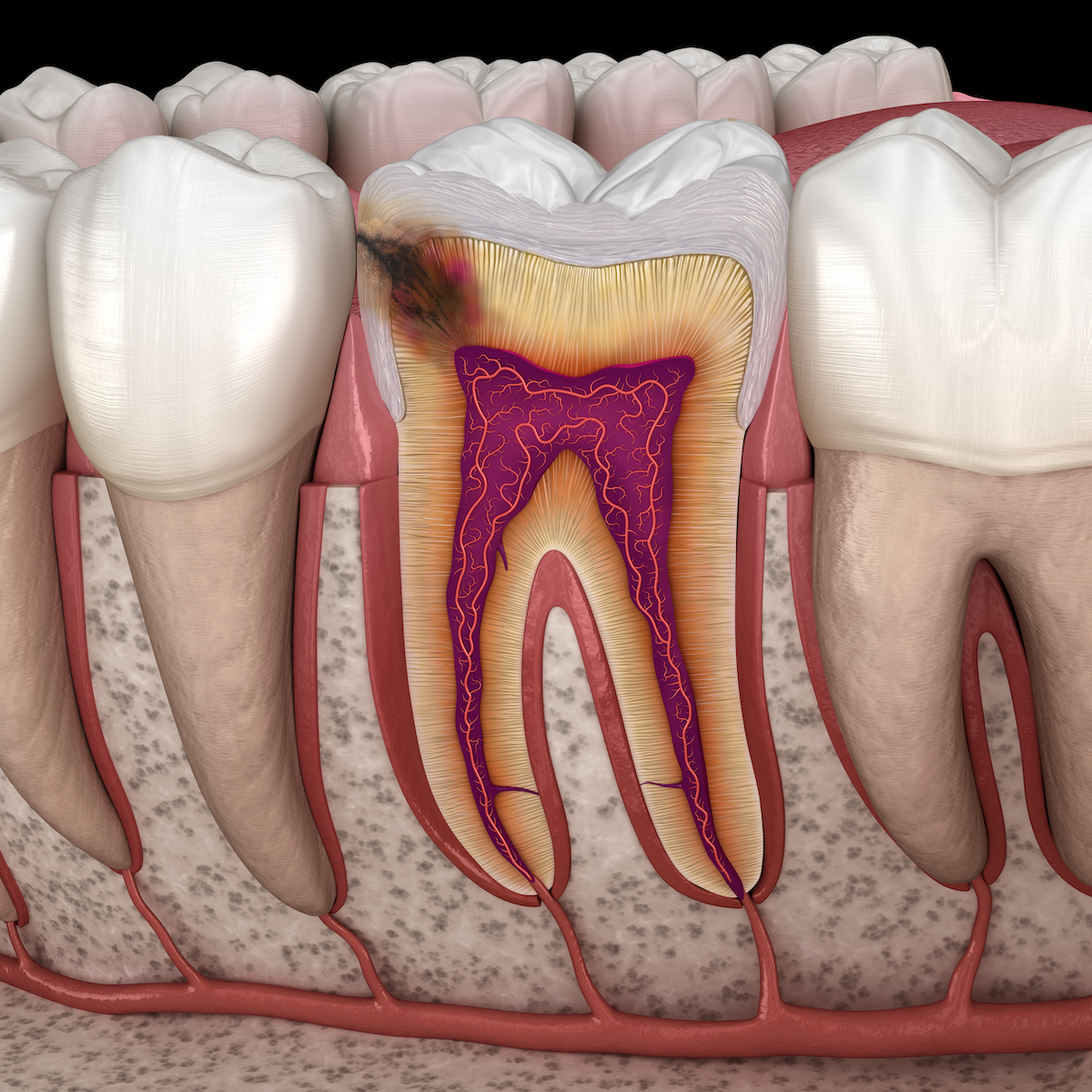 cavities, caries, dental cavity, filling